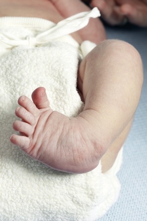 How to recognise if my baby's feet are normal or needs treatment? Clubfoot, baby  feet turning inward or outward