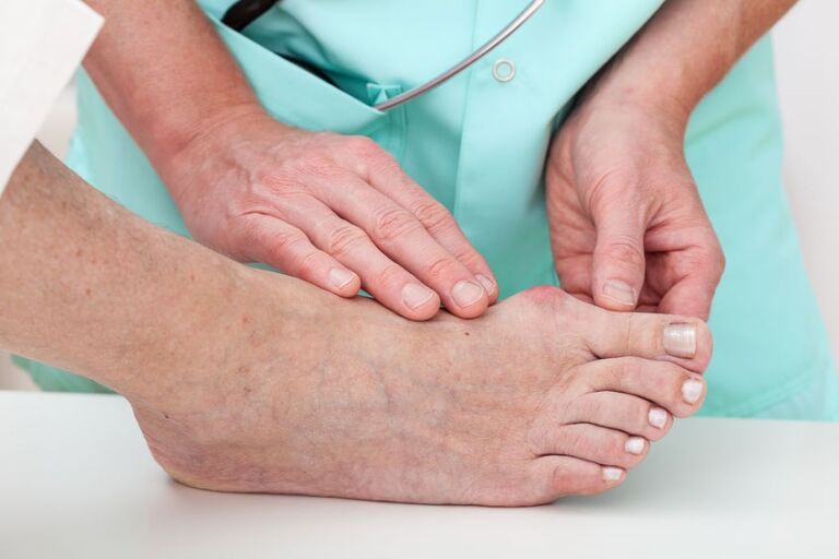 Bunion Treatment Doesn’t Have to Mean Surgery
