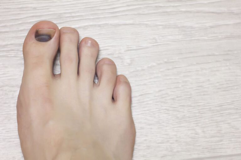 How to Treat a Bruised Toenail