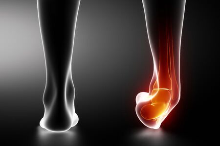 High Ankle Sprain: An Interview with a Ligament