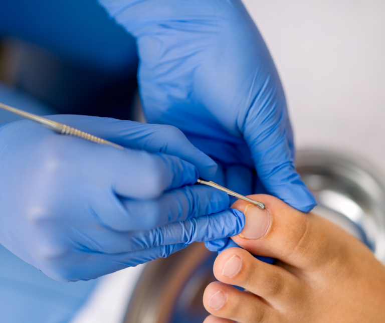 How to Get Rid of a Painful Ingrown Toenail and Prevent Serious Infections